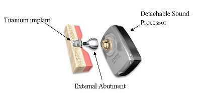 Conventional Bone Anchored Hearing Systems