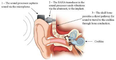 How a Bone Anchored Hearing System Works
