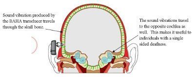 How a Bone Anchored Hearing System Works